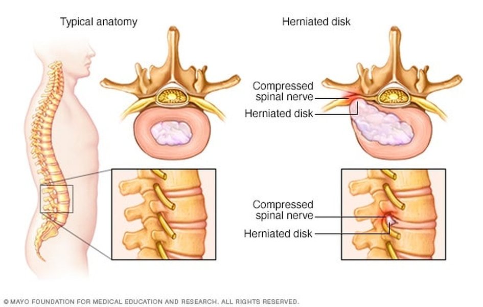 herniated-disc-treatment-comprehensive-guide-sz6vngjn