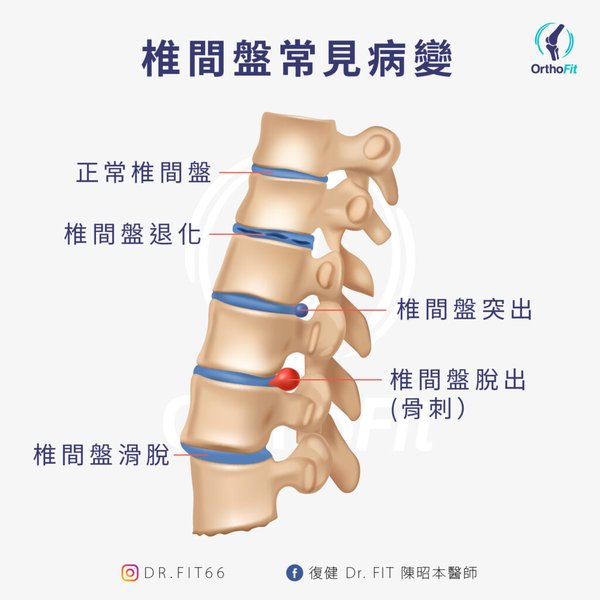 herniated-disc-walking-difficulty-solutions-r1ds6d9a