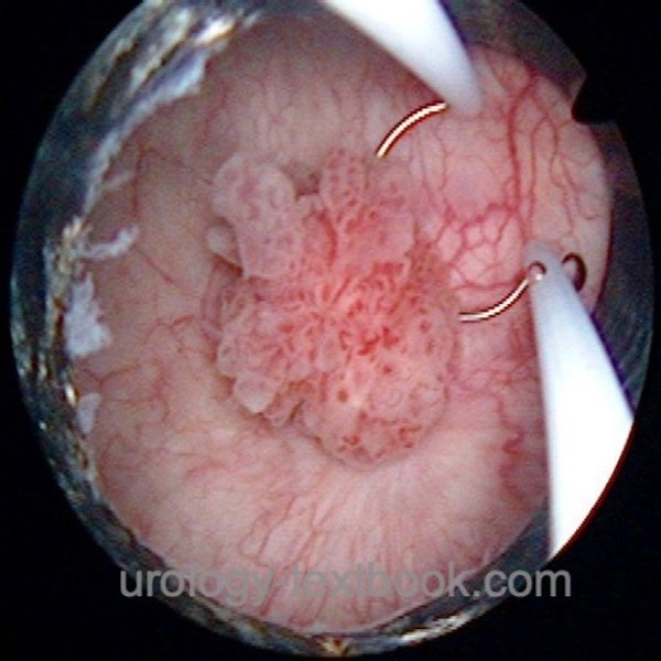high-grade-bladder-cancer-overview-tpeil1k5