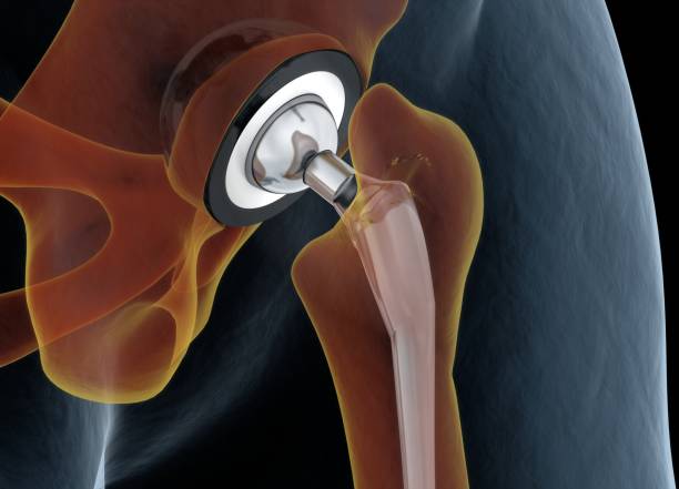 elderly hip replacement surgery