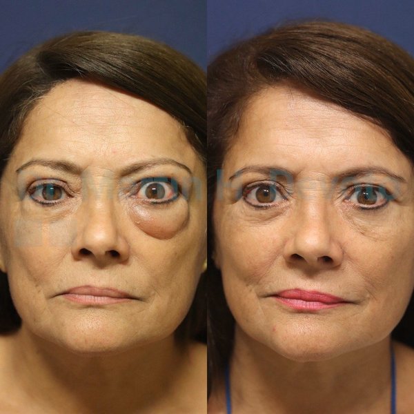 Persona con ojos afectados por enfermedad tiroidea