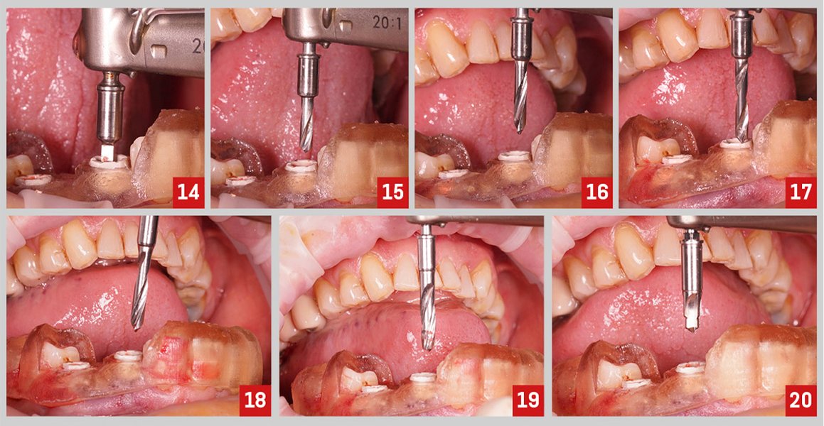 A guided immediate implant placement procedure with bone regeneration and immediate loading.