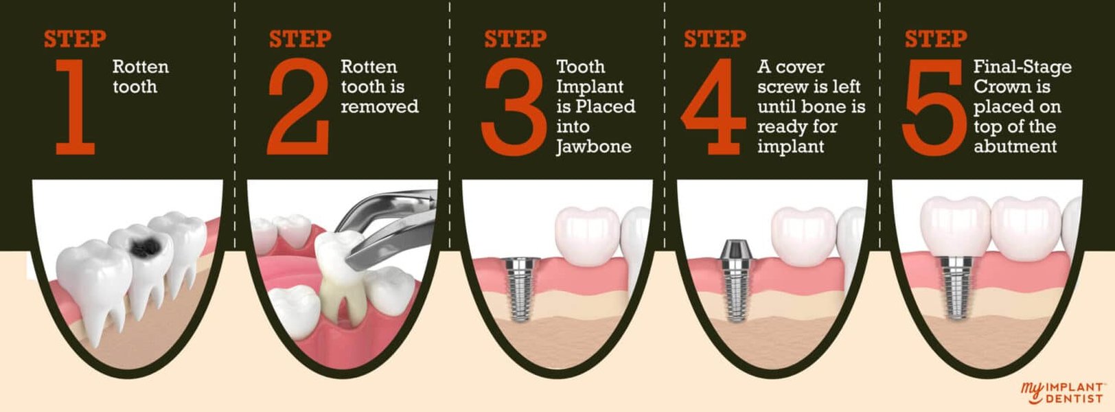 A step-by-step illustration of the dental implant procedure.