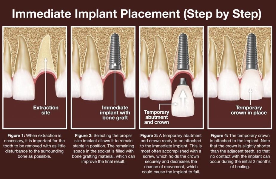 immediate-loading-dental-implants-xzgdk9iw