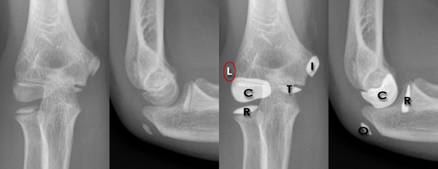 wrist and elbow injury radiograph