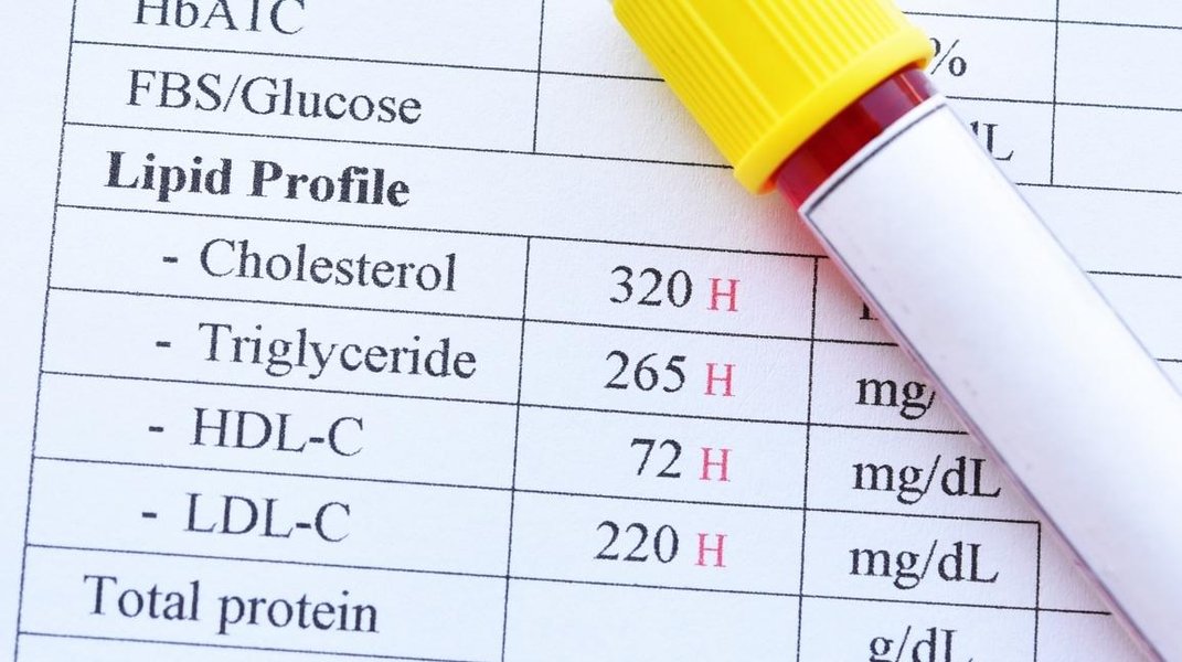 interpreting-cholesterol-blood-test-k4r9hipq