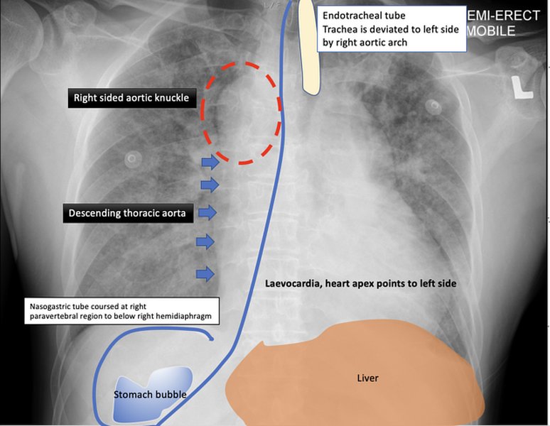 Radiological image showing features consistent with left isomerism, highlighting polysplenia.