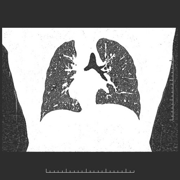 Chest X-ray indicating features suggestive of right isomerism.