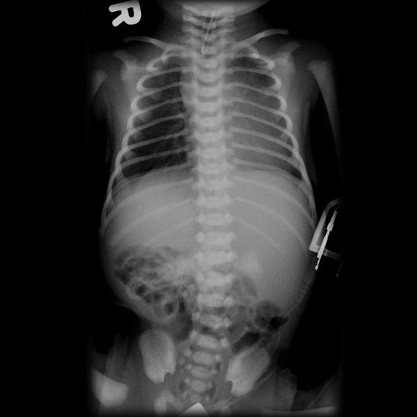 Illustration showing abnormal organ arrangement in heterotaxy syndrome.