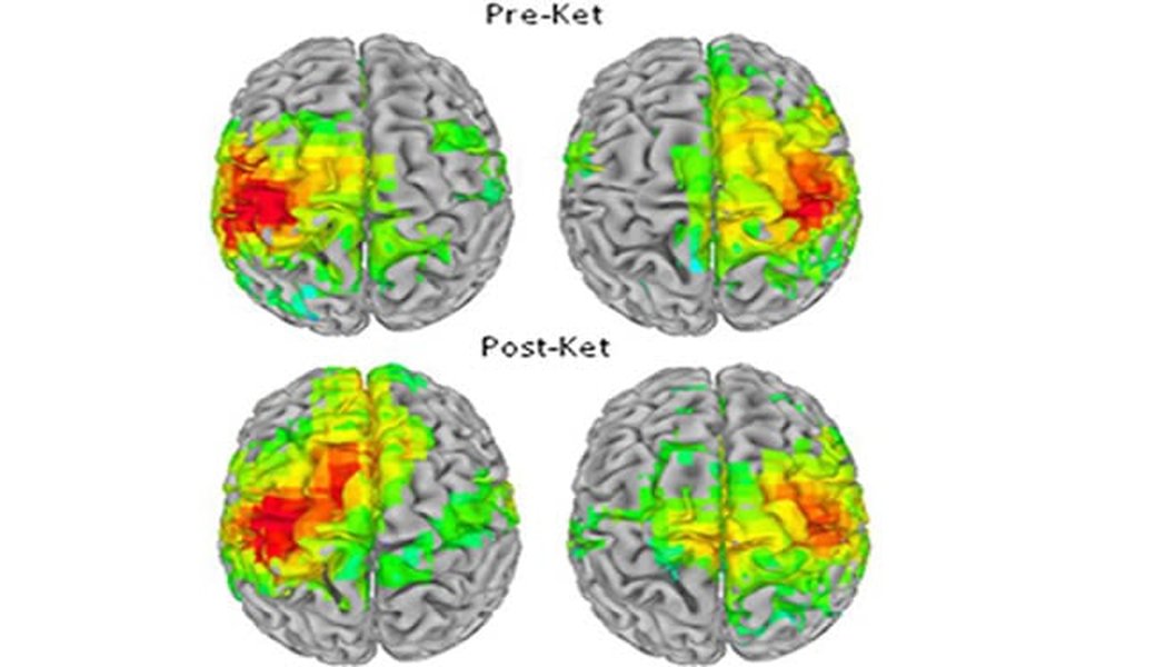 Brain scans showing ketamine effects