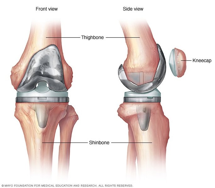 orthopedic knee implant surgery