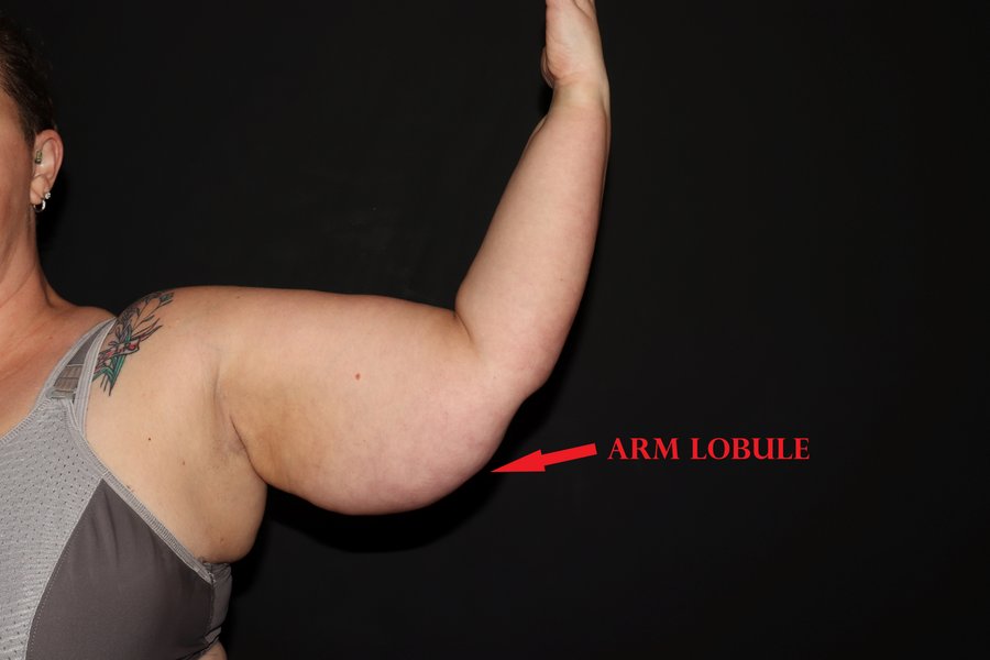 Image of Lipedema on an arm with lobules labeled
