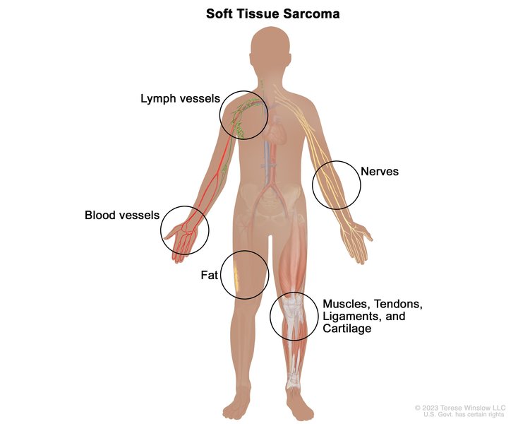 Image of a soft tissue sarcoma cell