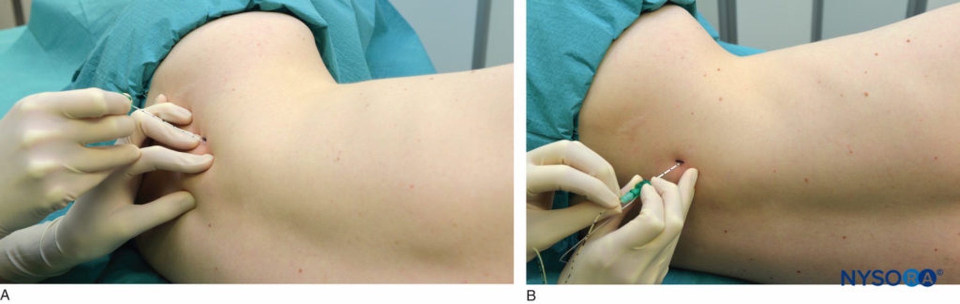 Needle insertion technique for lumbar plexus block