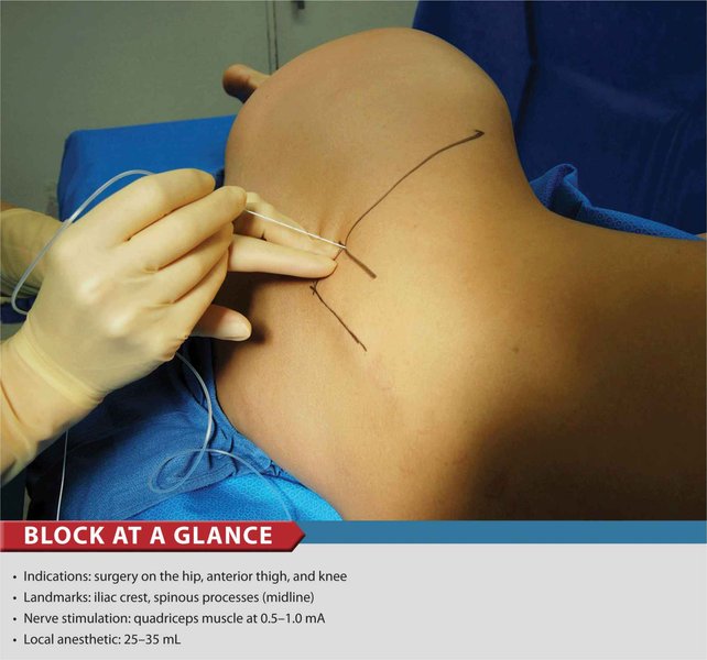 lumbar-plexus-block-nerve-stimulator-lcxyl64d