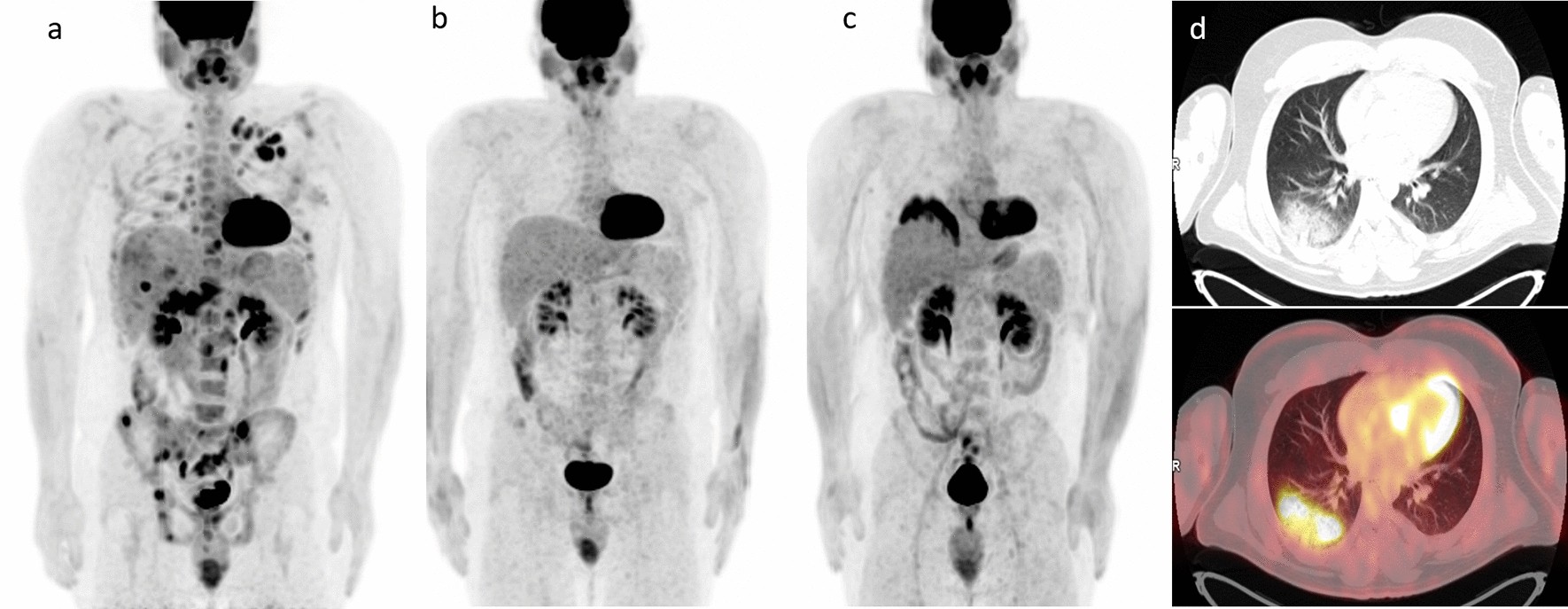 FDG PET scan lymphoma imaging