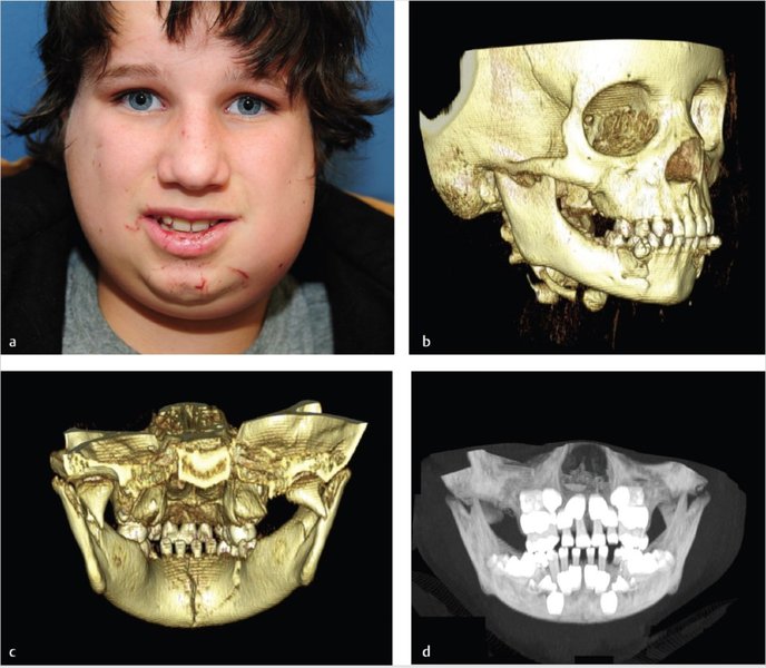 child mandible diagnosis