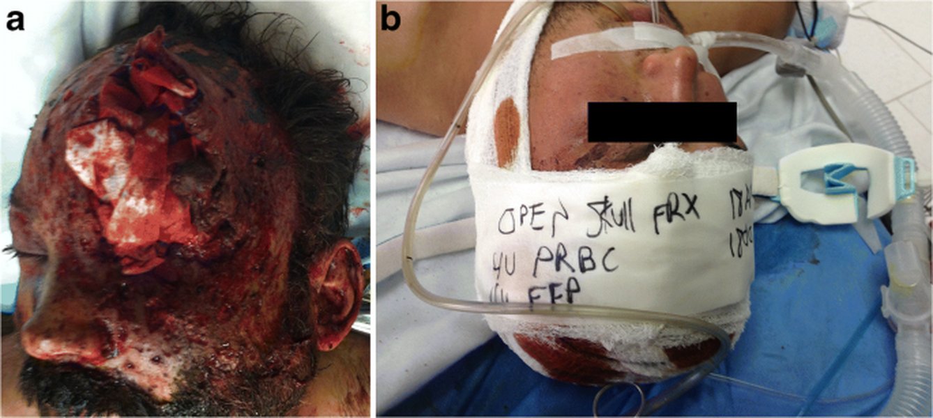 Diagram illustrating zones of craniofacial injury relevant to battlefield trauma.