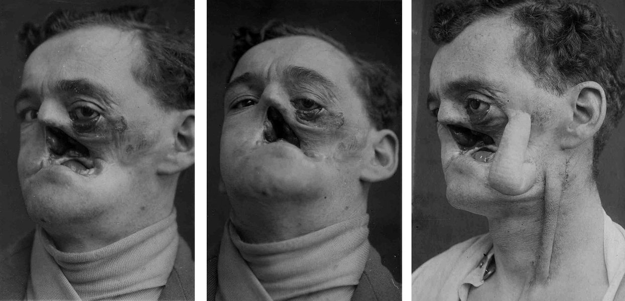 maxillofacial-war-trauma-review-8e5ej737