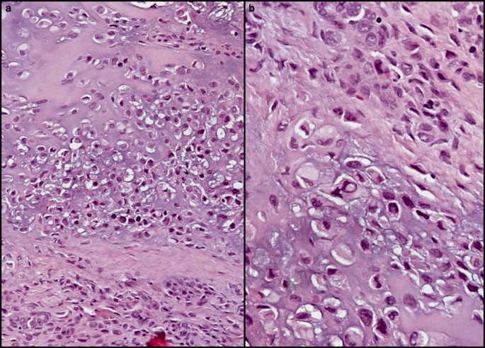 melanoma tumor cells microscope