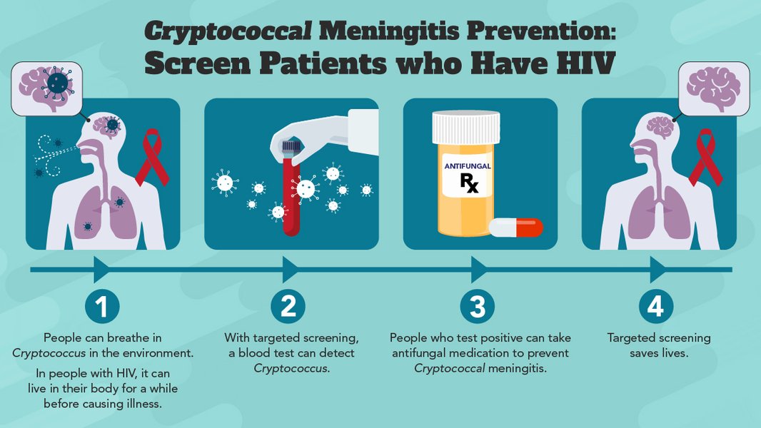 Estadios de la meningitis criptocócica y su progresión