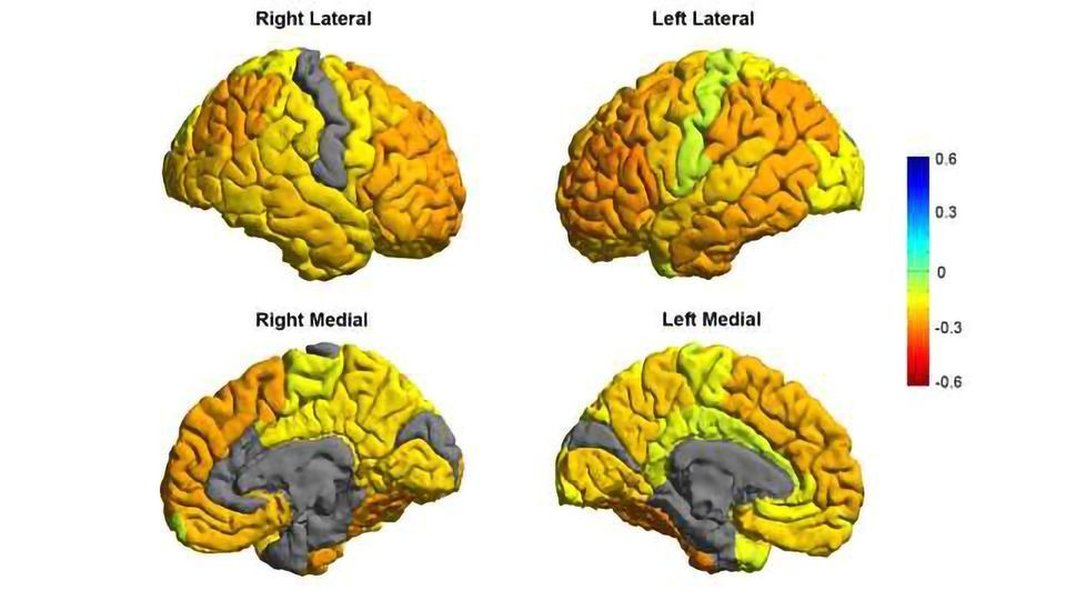 brain scans mood disorders