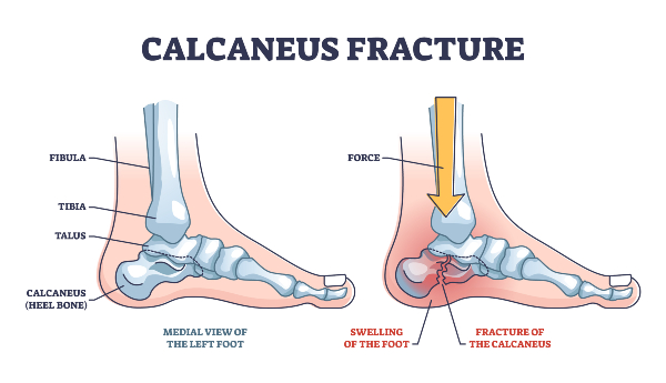foot pathology, heel anatomy, orthopaedic shoes