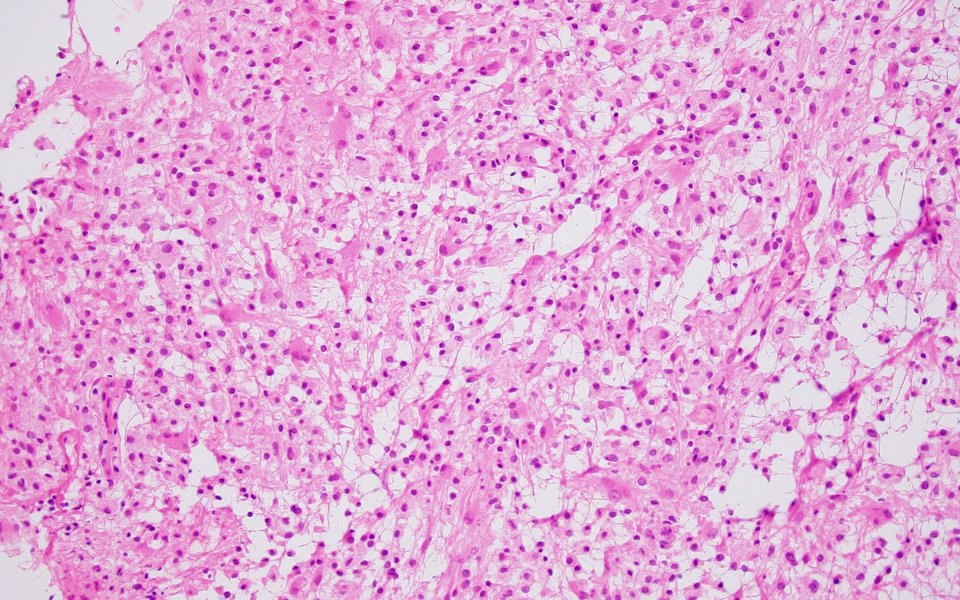 ms-lymphocytic-infiltration-nuances-4zq2x91i