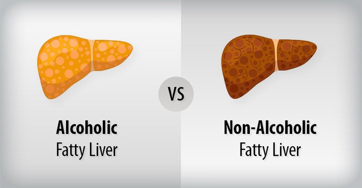 nafld-vs-healthy-controls-comparison-abbx18tl