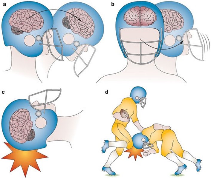 brain trauma clinical