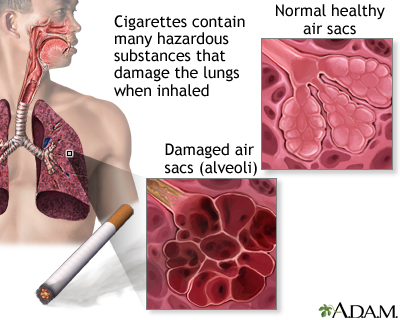 smoking cigarette pulmonary alveoli
