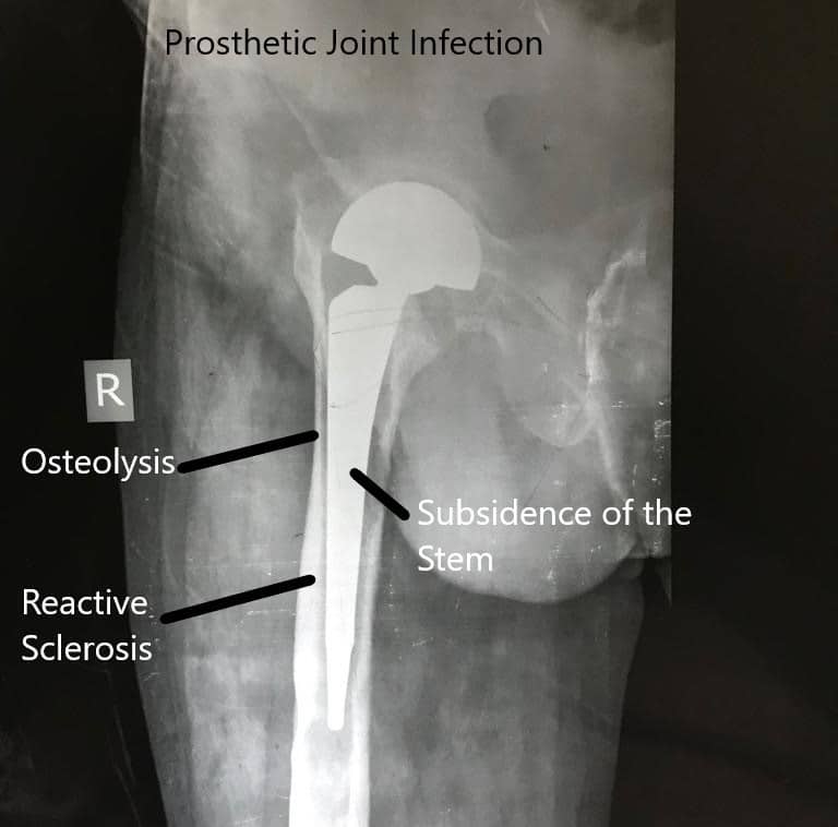 infected hip hardware treatment