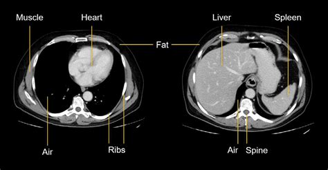 CT scan of abdomen