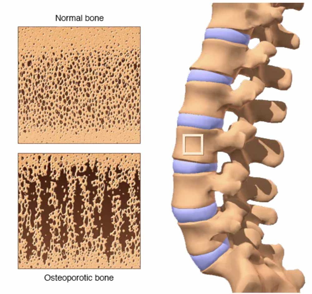 osteoporosis bone density scan exercise