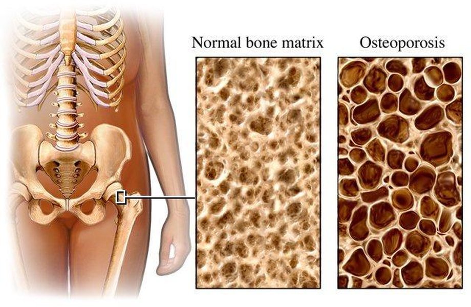 An illustration depicting the skeletal structure, highlighting the importance of bone health.