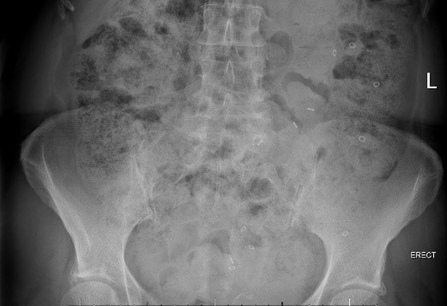 parkinsons-post-prostatectomy-constipation-48cpai1x