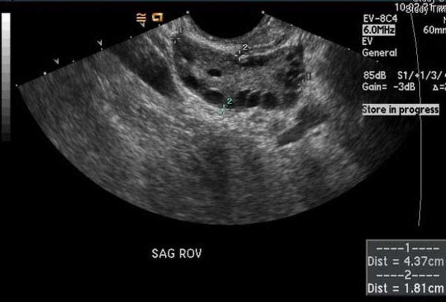 pcos-symptoms-explained-comprehensively-h6kv3k7a