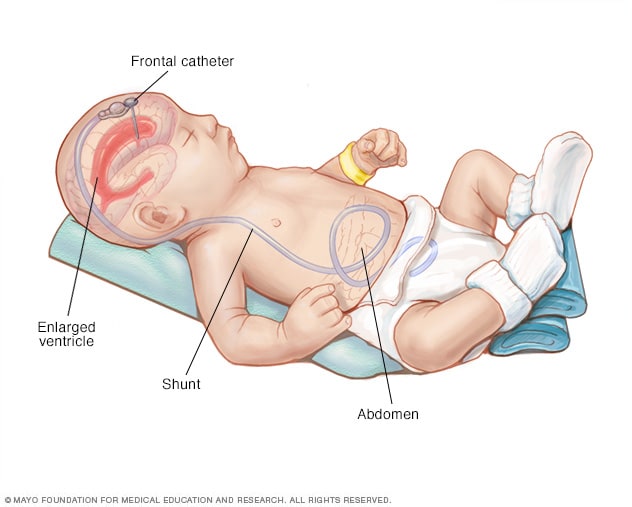 hydrocephalus treatment surgery equipment