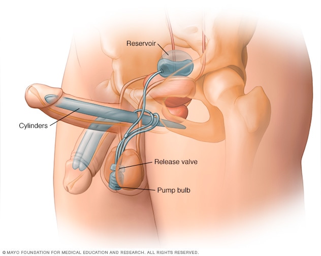 penis enlargement physical devices and surgical tools