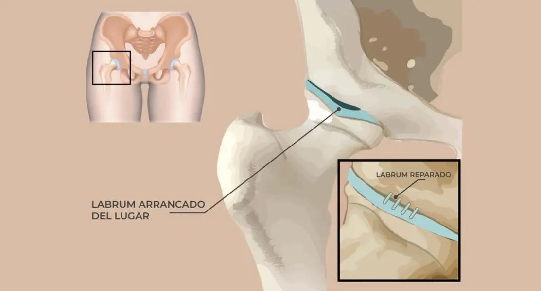 plan-entrenamiento-cadera-lesion-labrum-30fkx7o9