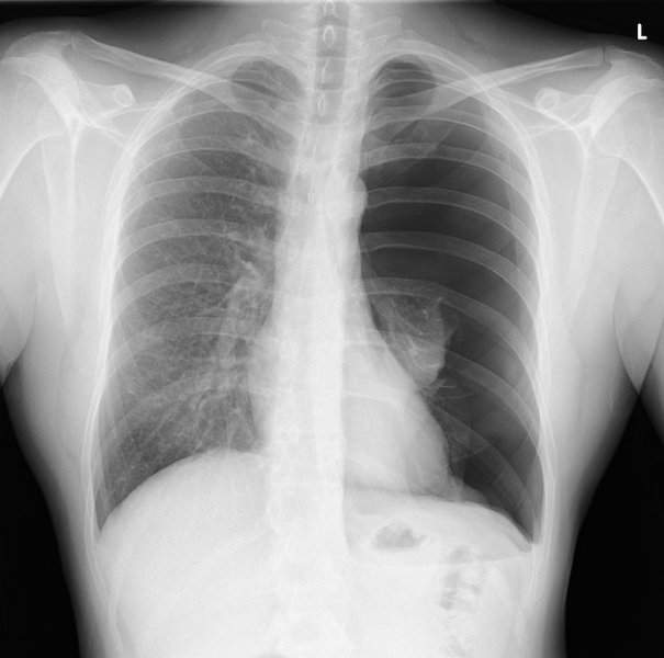 pneumothorax-pleural-disease-explained-njvvjban