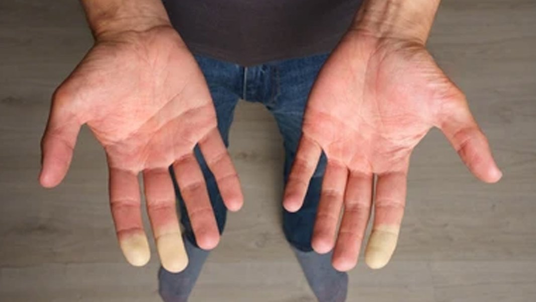Hands showing color changes typical of Raynaud's phenomenon