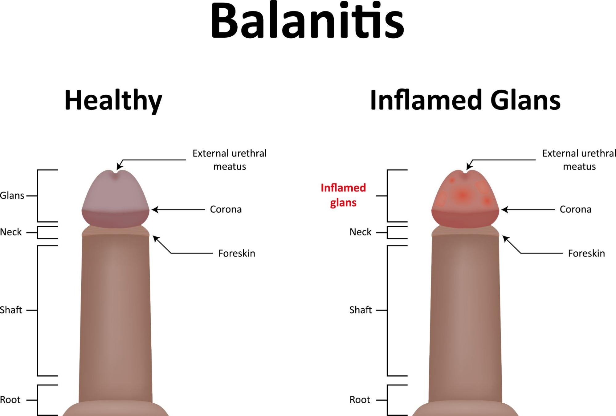 penile foreskin inflammation treatment