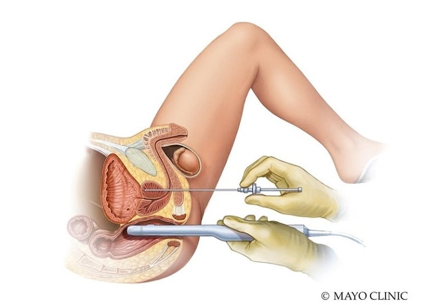 Image depicting the setup for a Transperineal Biopsy