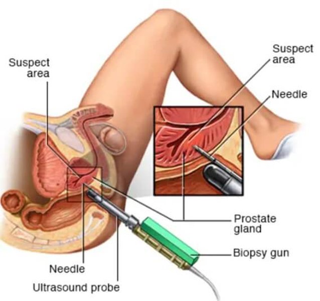 MRI-Ultrasound fusion biopsy technology