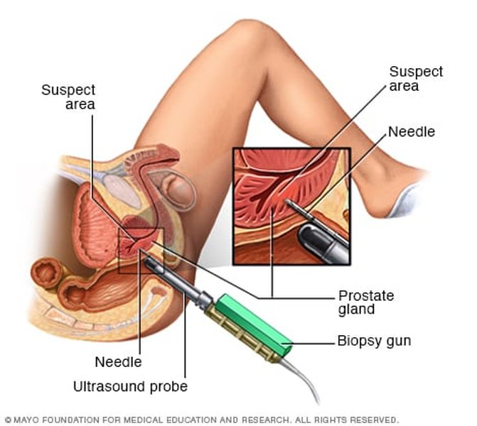 prostate-biopsy-procedures-guide-ldasdbif