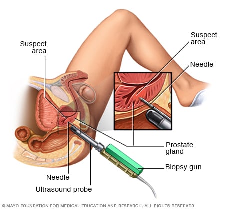 prostate biopsy procedure instruments and medical clinic