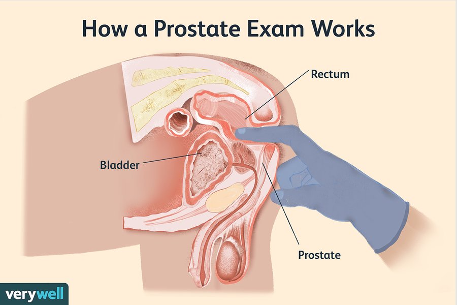 A doctor performing a digital rectal exam on a patient.