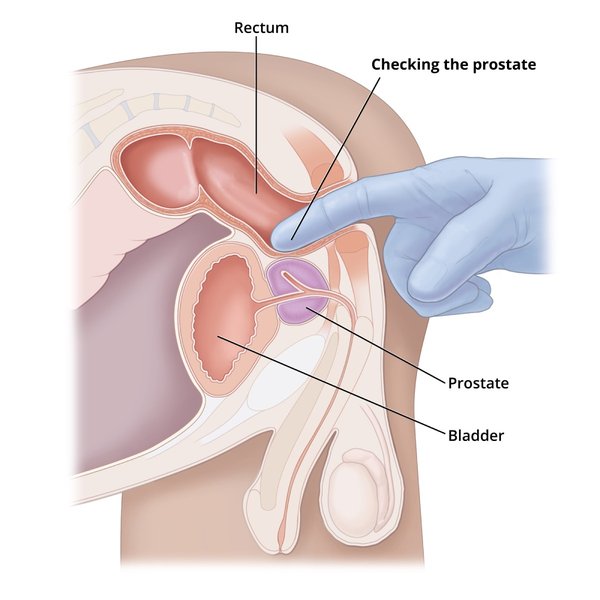 prostate-exam-usa-germany-lkrlu0du