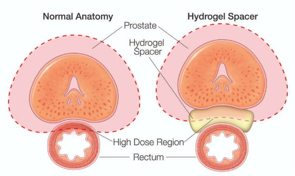 prostate-imrt-tissue-healing-timeline-m41urkqt